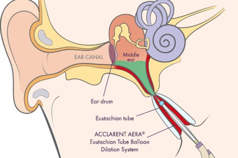 Advanced ENT Treatments Balloon Sinuplasty Baha Ear Implant